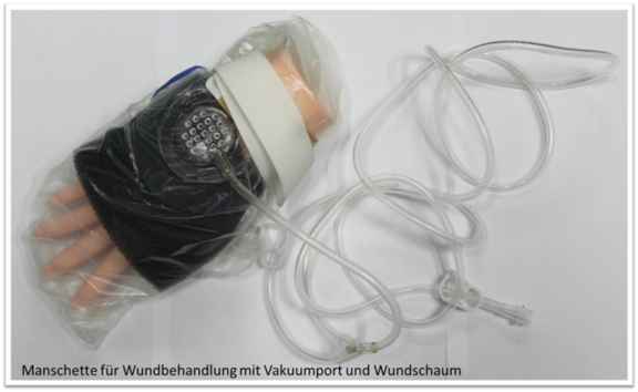 Manschette für Wundbehandlung inklusive Vakuumport und Wundschaum zum Absaugen des Wundsekrets, Prototyp hergestellt von Fa. iSKiA, mit der im Projekt entwickelten Folie